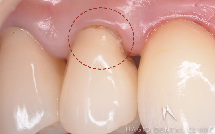 歯肉縁下形成をしていない状態（赤丸の歯茎の位置が少し下がっています）
