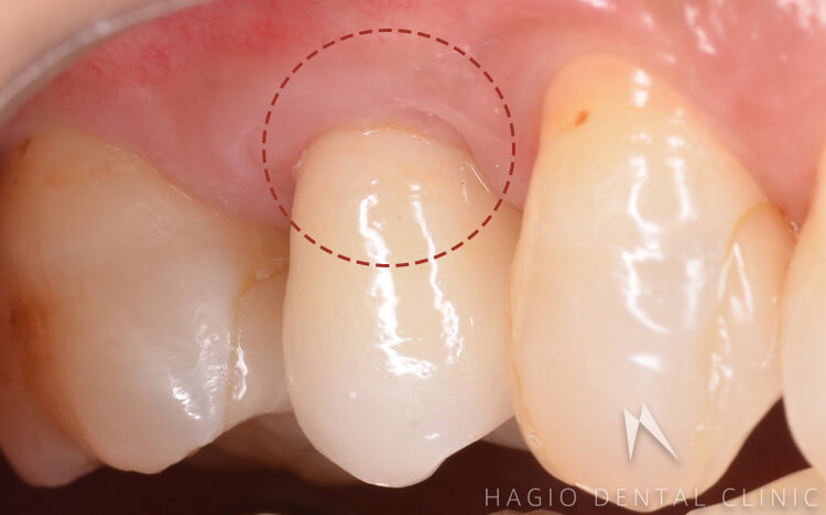歯肉縁下形成を行った状態（赤丸の歯茎の位置上に上がってきています）